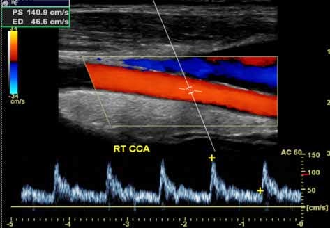 carotid-dopwave4
