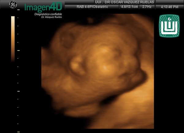 1- Diagnóstico por ultrasonido de Artrogriposis. Dr. Vázquez Ruelas. Imagen 4d