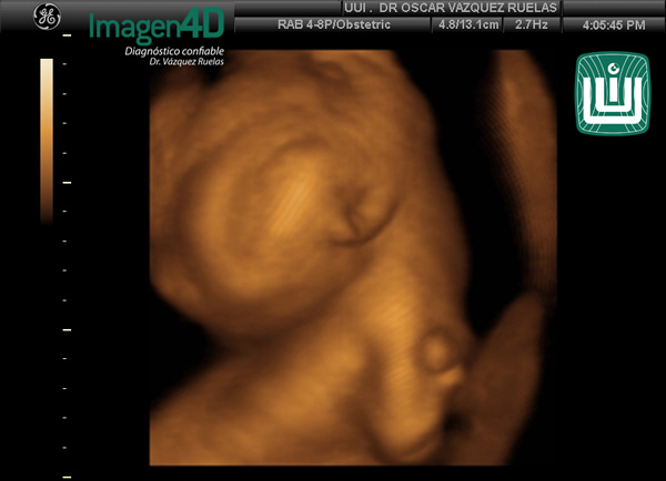 2- Diagnóstico por ultrasonido de Artrogriposis. Dr. Vázquez Ruelas. Imagen 4d
