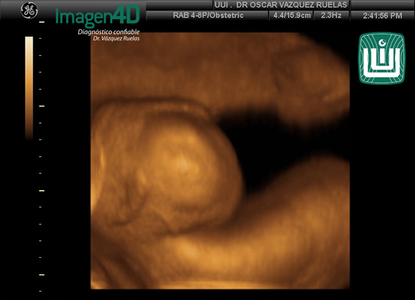 3- Diagnóstico por ultrasonido de Artrogriposis. Dr. Vázquez Ruelas. Imagen 4d