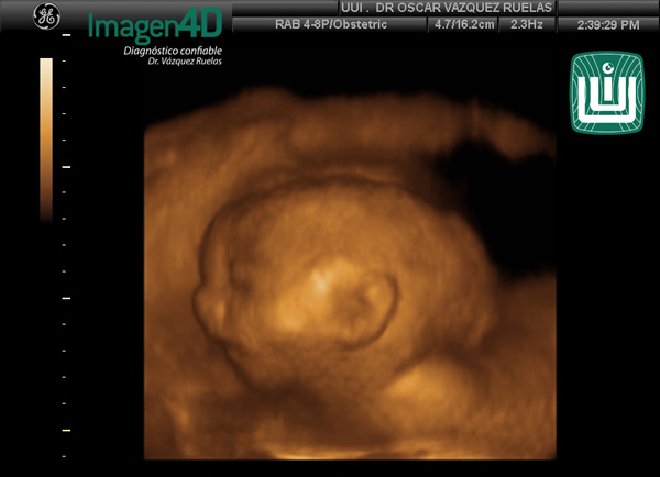 4- Diagnóstico por ultrasonido de Artrogriposis. Dr. Vázquez Ruelas. Imagen 4d