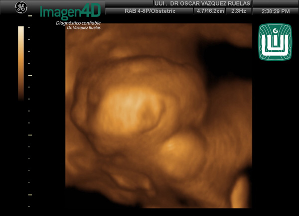 5- Diagnóstico por ultrasonido de Artrogriposis. Dr. Vázquez Ruelas. Imagen 4d