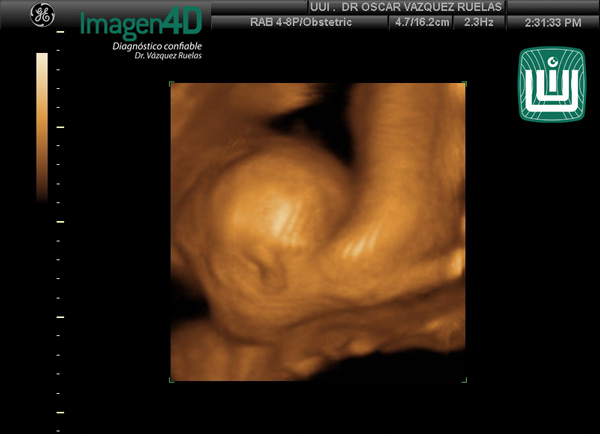 6- Diagnóstico por ultrasonido de Artrogriposis. Dr. Vázquez Ruelas. Imagen 4d
