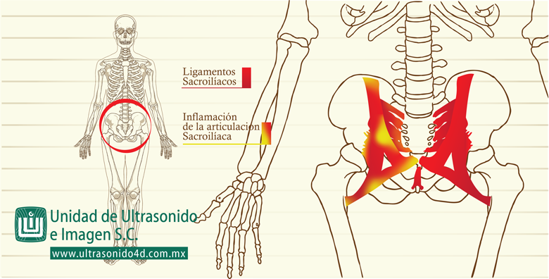 sacroilitis - unidad de ultrasonido e imagen - dr oscar vazquez ruelas